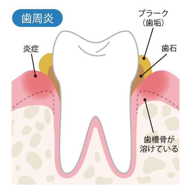 歯周病のなりたち