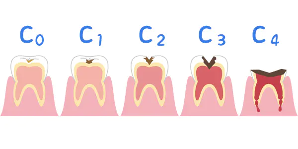 むし歯の分類と治療方法