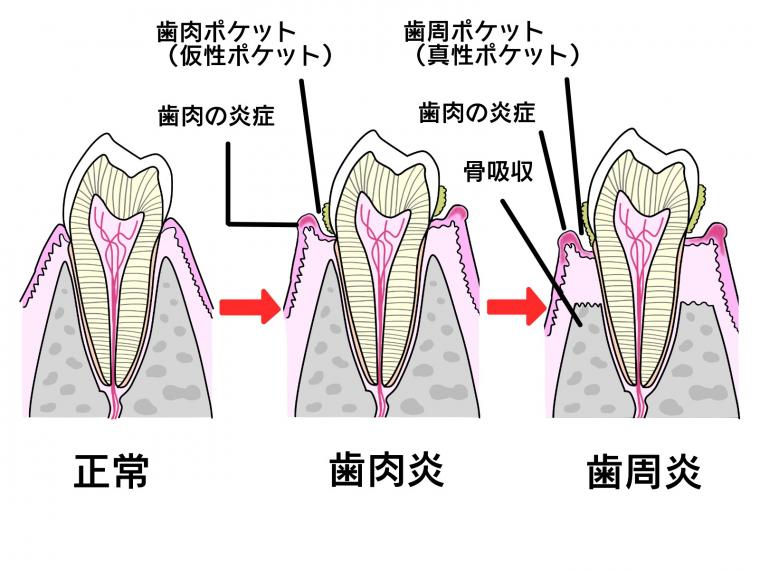 心臓病は歯周病で引き起こされる？