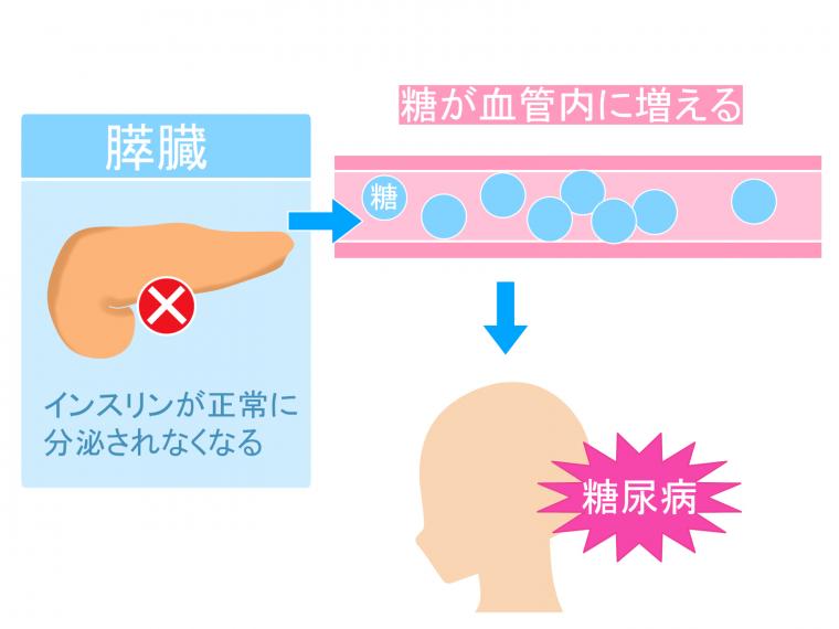 心臓病は歯周病で引き起こされる？