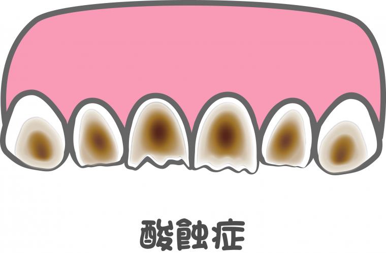 無糖の炭酸水も歯に悪いの？