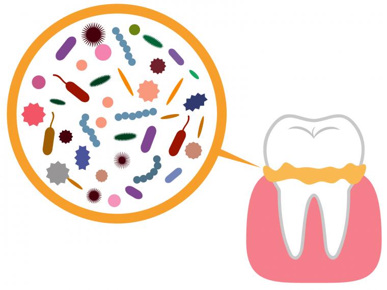 むし歯はどうしてできるの？—原因を知って、今日からできる予防法！