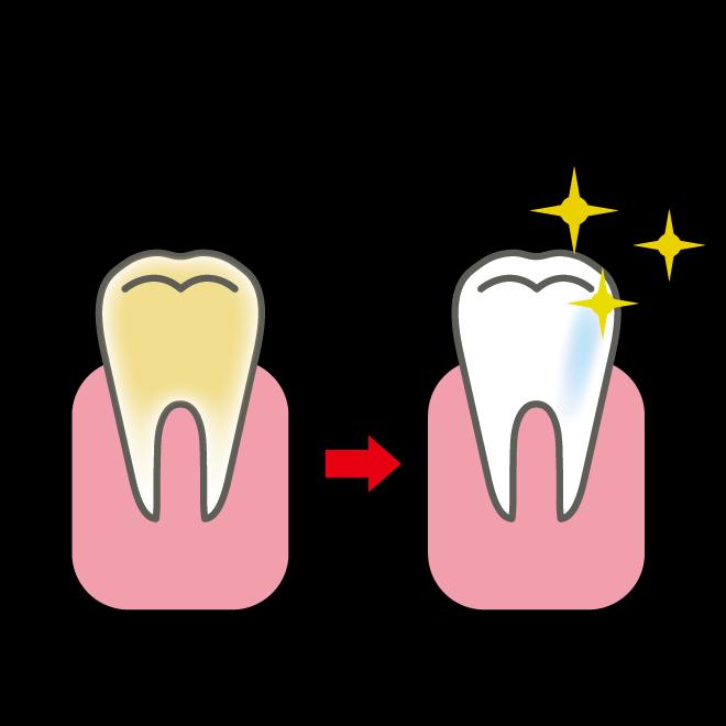 歯のホワイトニング
