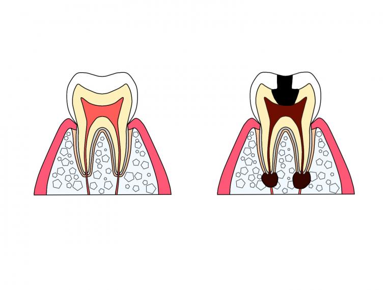 歯の痛みがピタッと止まったら、むし歯は治ったの？—実は非常に危険なサインかもしれません