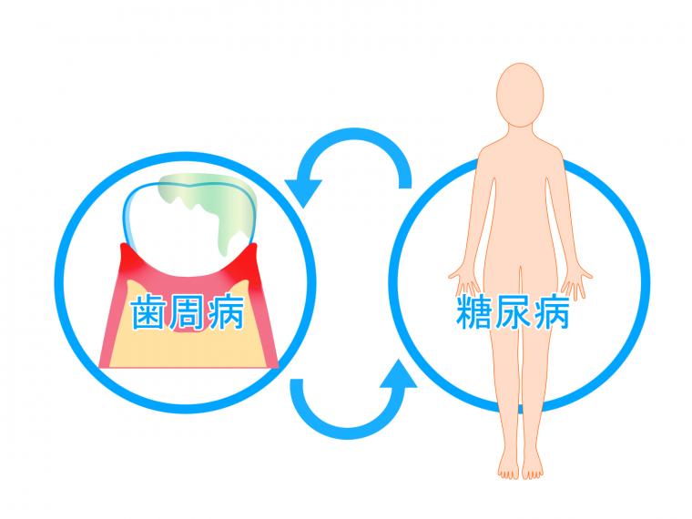 お口だけでない 全身に関係するお口の病気 歯周病