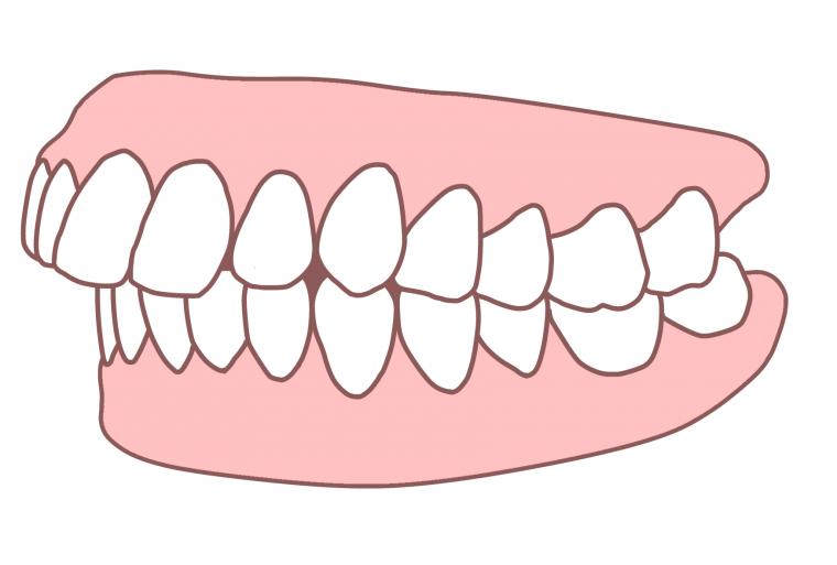 出っ歯にならないために