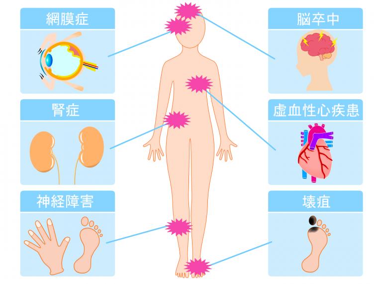 歯周病は糖尿病の合併症