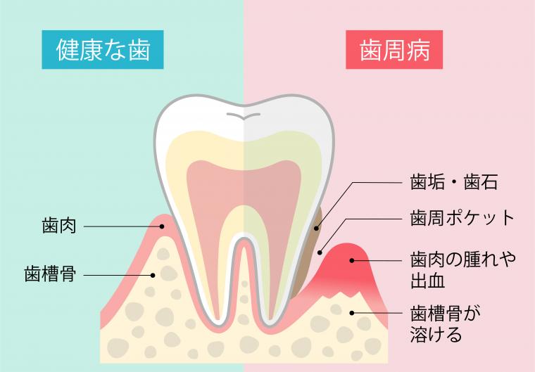 歯周病と全身疾患①（糖尿病・心臓病・脳梗塞との関係）