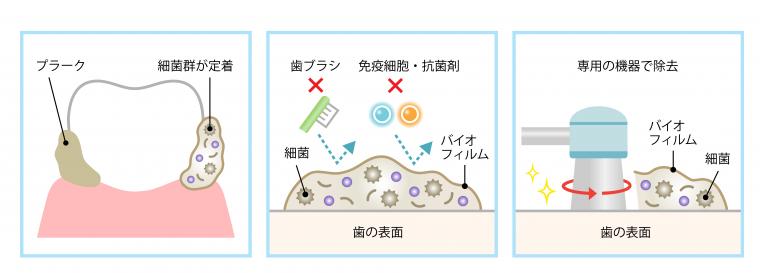 歯周病と全身疾患②｜誤嚥性肺炎・認知症・妊娠への影響と予防の重要性