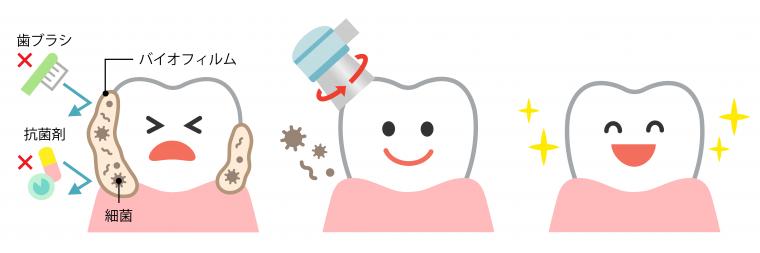 あなたは一生、好きなものを食べ続けられますか？歯を失う原因と「歯の一生」④