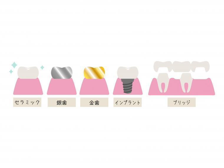 詰め物や被せ物、何を選ぶのが正解?「保険外は押し売り?」の疑問に答えます