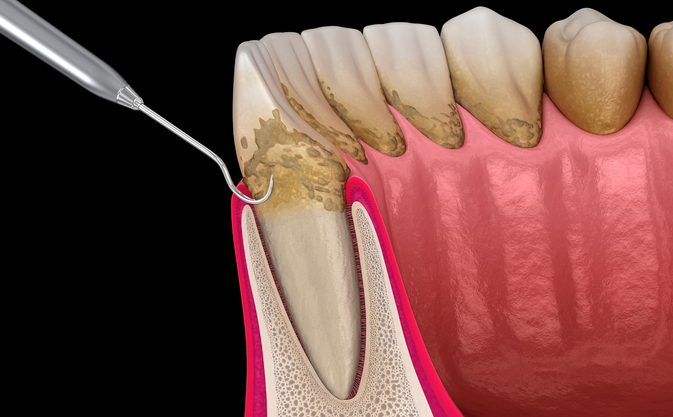 歯周外科治療で重度の歯周病を改善